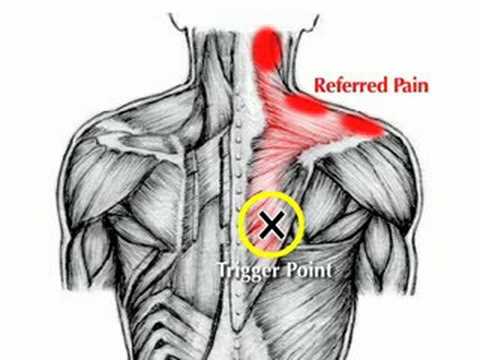 trigger point