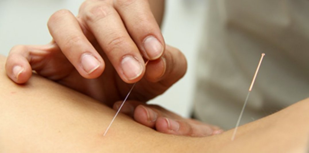 needling