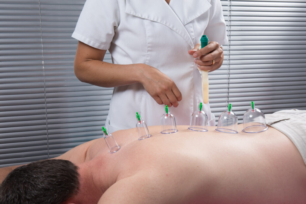 Therapist performing cupping therapy on a patient’s back.