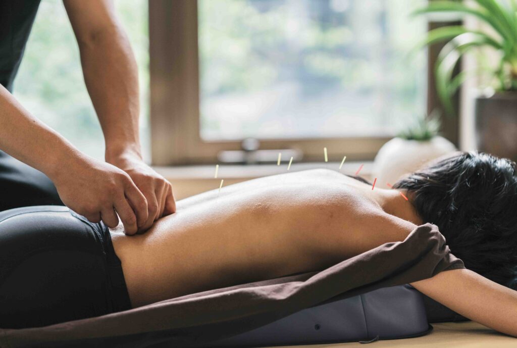 Women on table with acupuncture needles on her back.