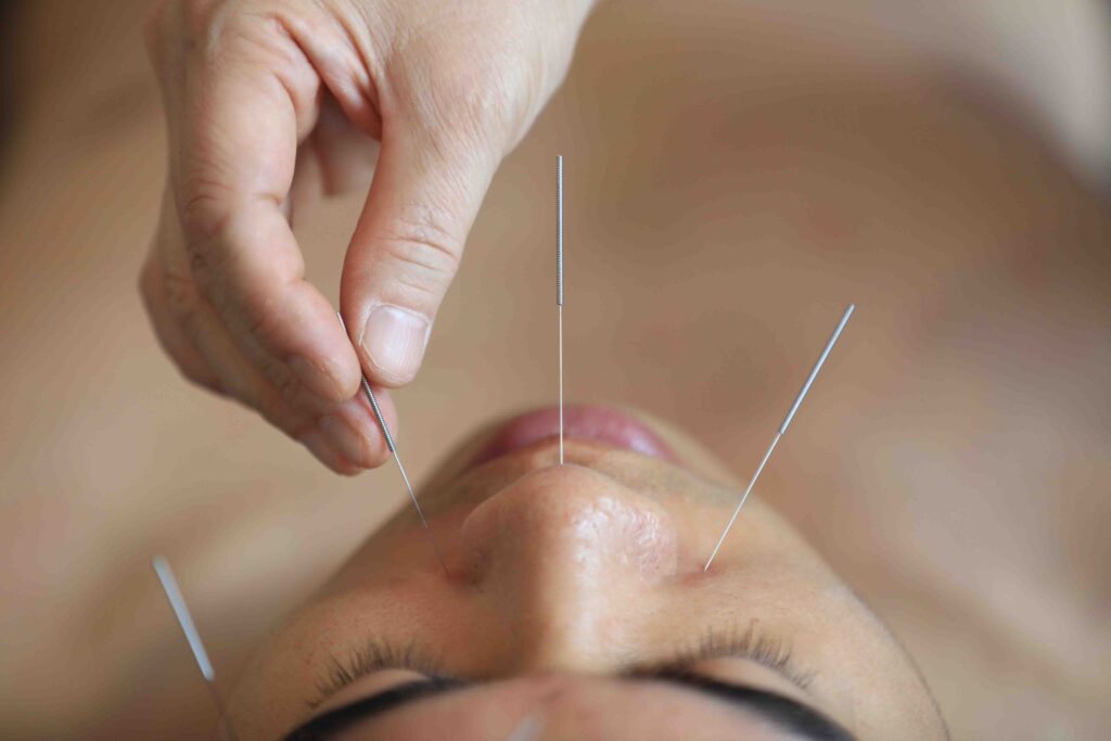 Person getting acupuncture treatment.