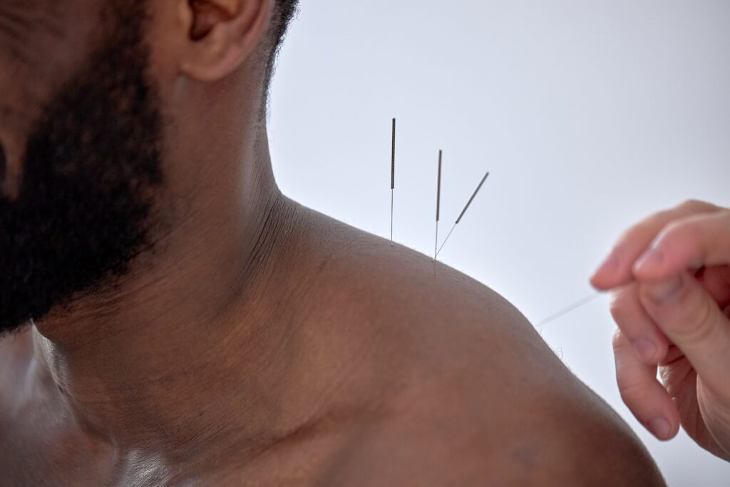 Man with acupuncture needles on shoulders.