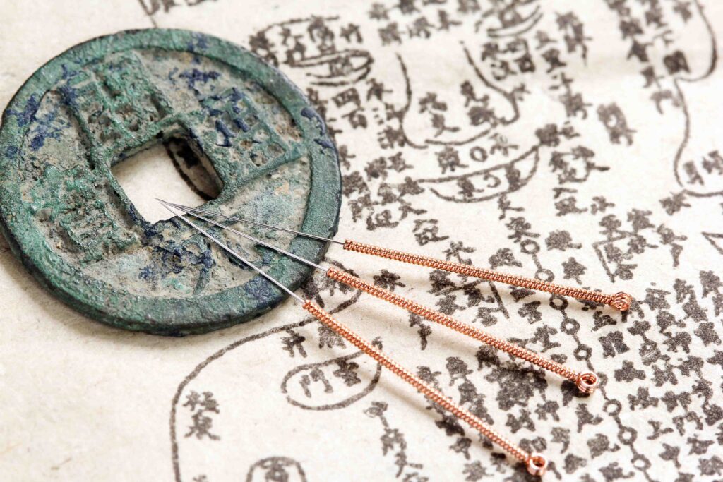 Acupuncture needles.