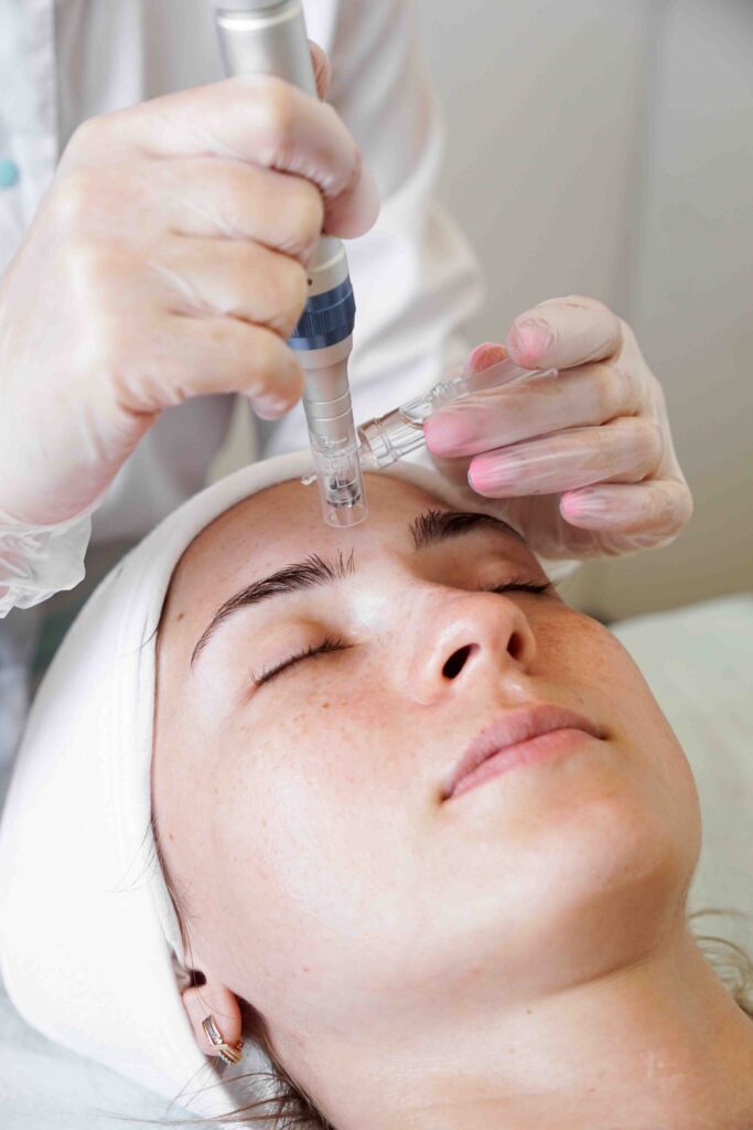 Woman getting microneedling.