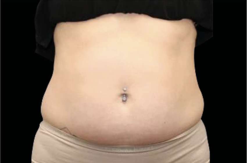Photo of abdomen before Emsculpt treatment.