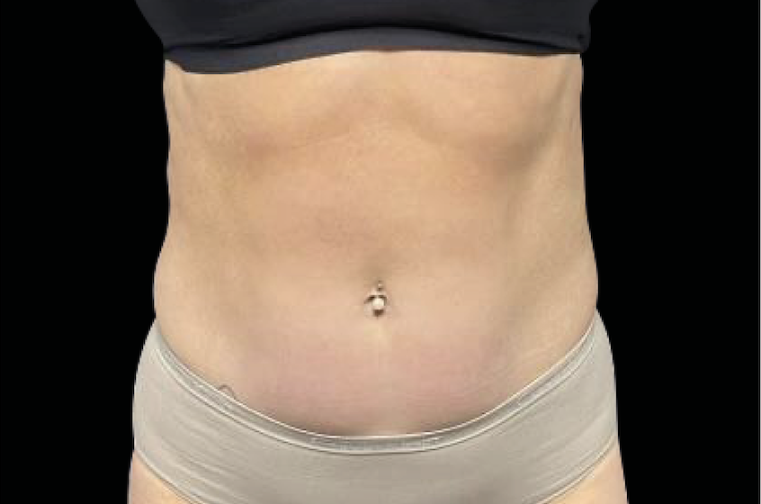 Photo of tightened abdomen after Emsculpt treatment.